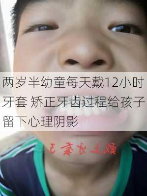 两岁半幼童每天戴12小时牙套 矫正牙齿过程给孩子留下心理阴影