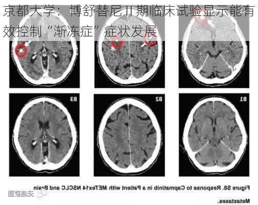 京都大学：博舒替尼Ⅱ期临床试验显示能有效控制“渐冻症”症状发展