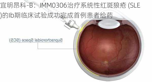 宜明昂科-B：IMM0306治疗系统性红斑狼疮 (SLE)的Ib期临床试验成功完成首例患者给药